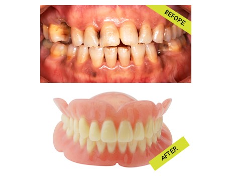 Upper Dentures San Antonio TX 78213